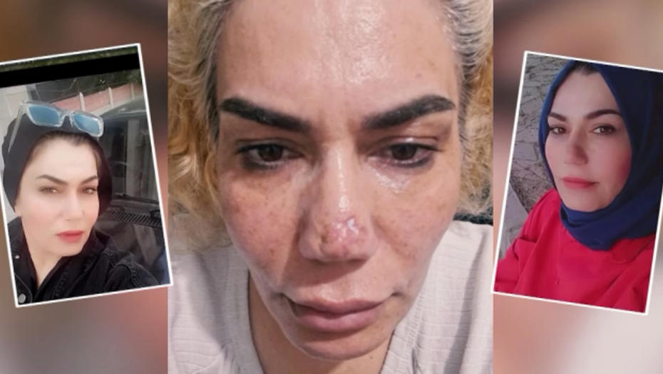 Estetik Ameliyat Sonrası Berbat Sonuçlar: Burnu Bu Hale Geldi, Doktordan Şikayetçi Oldu